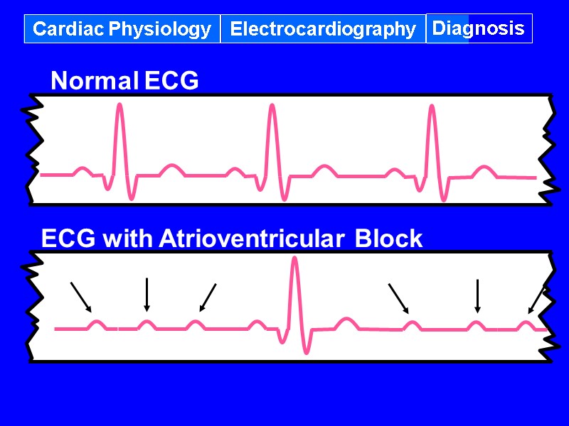 Cardiac Physiology Electrocardiography Diagnosis ECG with Atrioventricular Block Normal ECG